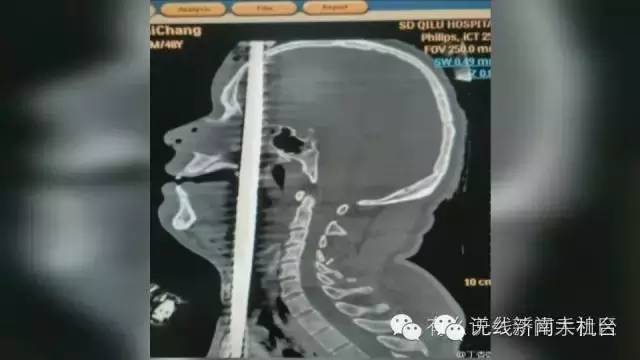 济南男子被1米长钢筋从阴部穿到脑部30名行家开颅开胸开腹手术7小时保住命