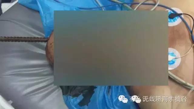 济南男子被1米长钢筋从阴部穿到脑部30名行家开颅开胸开腹手术7小时保住命
