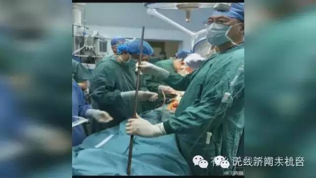 济南男子被1米长钢筋从阴部穿到脑部30名行家开颅开胸开腹手术7小时保住命