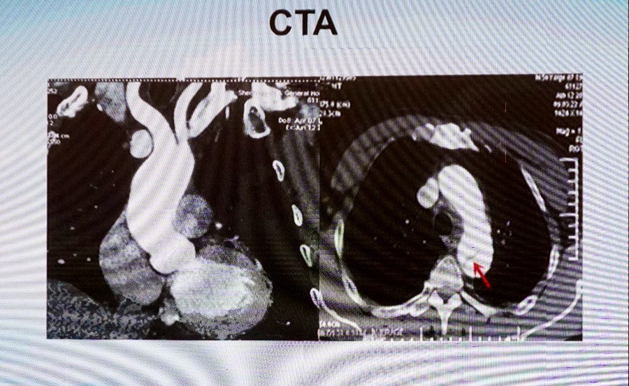 CCCPNCF2016勇攀高峰!主动脉夹层手术直播