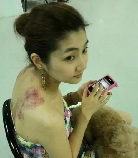 selina烧伤治疗过程,selina烧伤的皮肤恢复好了吗