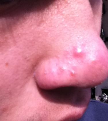 鼻子长痘痘怎么调理小妙招,鼻子长痘痘是上火吗