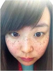脸色有斑点？只需30天，彻底清除色斑