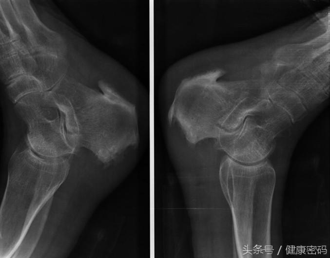 骨刺除了做手术有啥其他办法,有没有实用的方法治疗骨刺