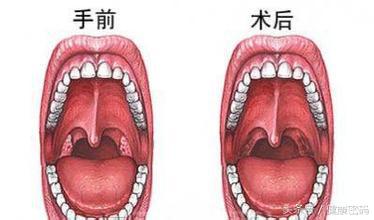 割掉扁桃体会影响免疫力吗,割掉部分扁桃体后还会发炎么
