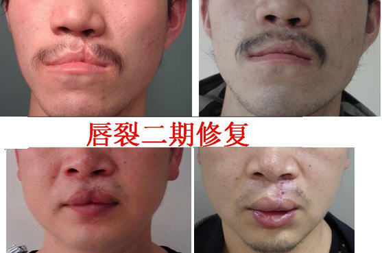 新生儿轻微兔唇是怎么造成的,怎么预防兔唇等缺陷