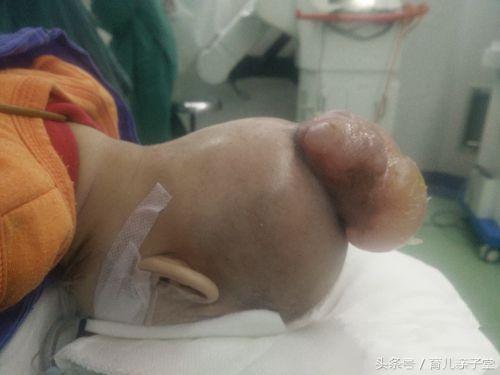 初生女婴头上长肉瘤，四月时长有两“脑袋”！
