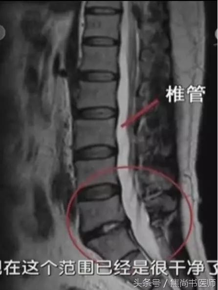 正骨法能不能治疗腰椎间盘突出,新医正骨能够治疗腰间盘突出症吗