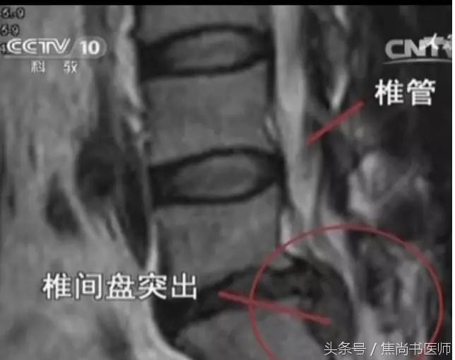 正骨法能不能治疗腰椎间盘突出,新医正骨能够治疗腰间盘突出症吗
