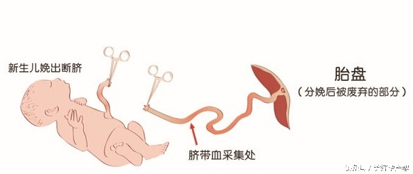 脐带血要不要留,脐带血究竟要不要保存