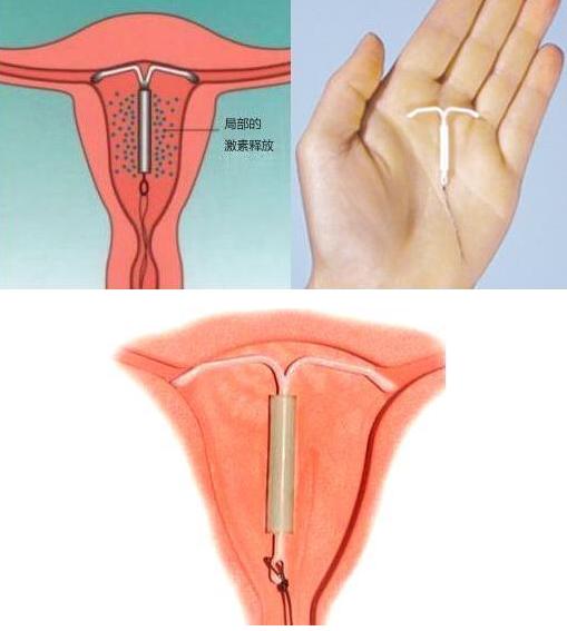 戴了二十多年环取出来是什么样的,上了20多年的环怎么取