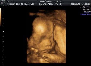 做四维医生说宝宝胎动幅度不大,四维胎动频繁和不怎么活泼对比