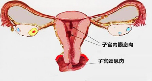 女性要注意，不要忽视宫颈息肉，病变可能会引发宫颈癌