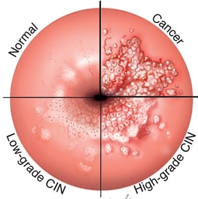 正常女性能够切除子宫吗,正常女性能够去切除子宫吗