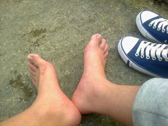 平板脚如何矫正,平板脚最佳锻炼方法