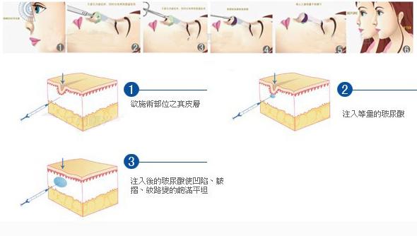 玻尿酸隆鼻的效果到底怎么样啊,玻尿酸隆鼻是不是合适每个人