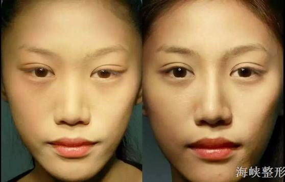 注射微整形需要了解哪些知识呢,注射美容和微整形有什么区别