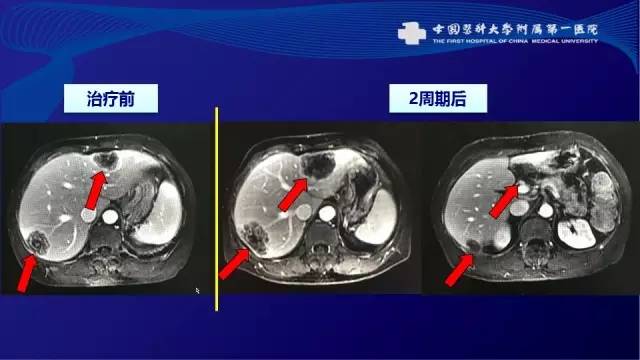肠癌肝转移同时性和异时性,邢宝才治疗肠癌肝转移告捷病例