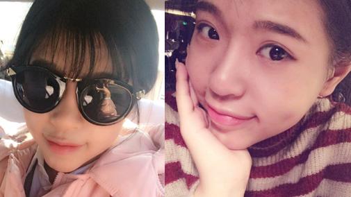 玻尿酸隆鼻的效果到底怎么样啊,玻尿酸隆鼻是不是合适每个人