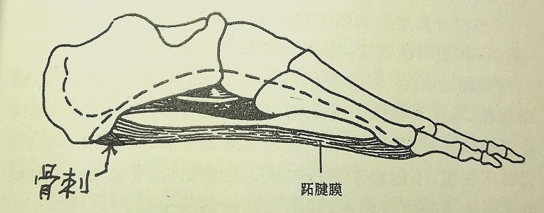 跟骨骨刺游离体治疗,跟骨骨刺跺脚管用吗