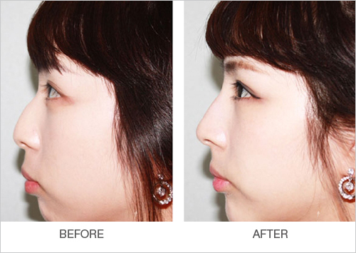 玻尿酸隆鼻的效果到底怎么样啊,玻尿酸隆鼻是不是合适每个人