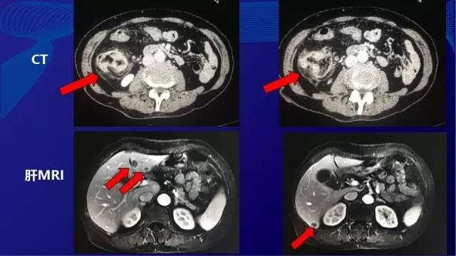 肠癌肝转移同时性和异时性,邢宝才治疗肠癌肝转移告捷病例