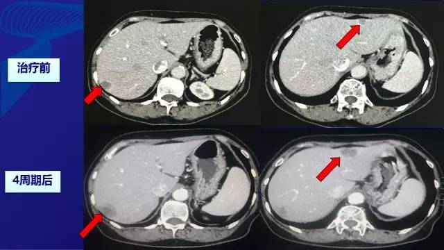 肠癌肝转移同时性和异时性,邢宝才治疗肠癌肝转移告捷病例