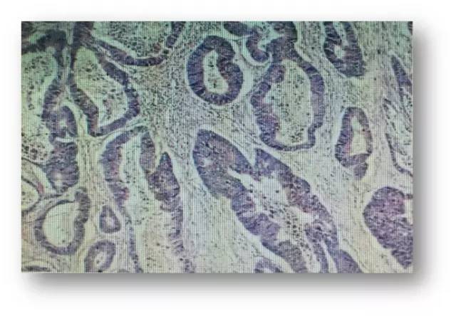 肠癌肝转移同时性和异时性,邢宝才治疗肠癌肝转移告捷病例