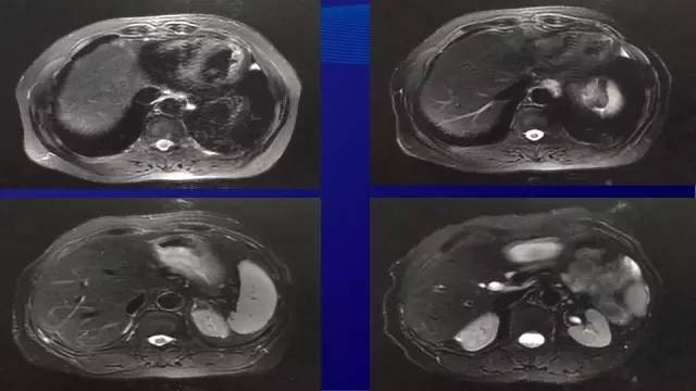 肠癌肝转移同时性和异时性,邢宝才治疗肠癌肝转移告捷病例