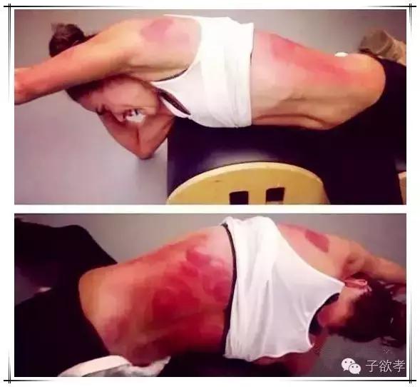 里约奥运会拔火罐,奥运会纹身