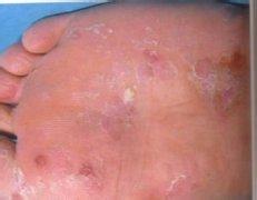 孕妇脚气能够用百肤宁吗,孕妇脚气有什么小妙招