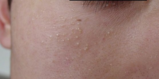 眼睛周围长出的这些小米粒儿，到底是什么呢？