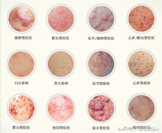 痘痘的生长过程视频,痘痘的发展过程素材