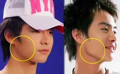 瘦脸针不合适什么病人,中年人合适打瘦脸针吗