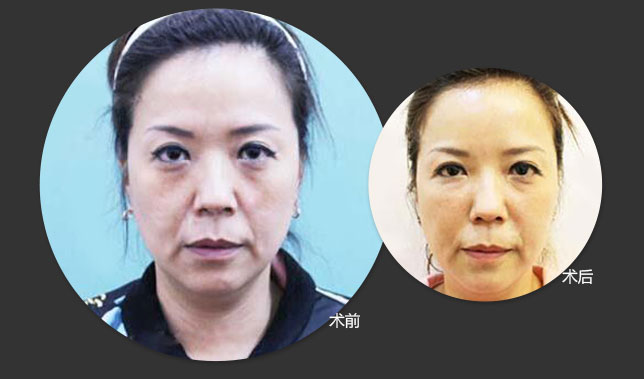 法令纹玻尿酸填充多久能洗脸化妆,法令纹填充玻尿酸会越填越深吗