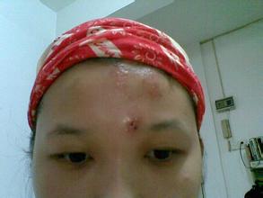 额头全是小米粒的痘痘怎么去掉,额头上有很多痘痘怎么办