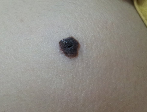 孙红雷曾说：得了黑痣赶紧点，千万别以为是好运和性感！真的吗？