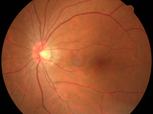 高度近视的孕妇能够顺产吗,视网膜脱离病史妈妈能够顺产吗