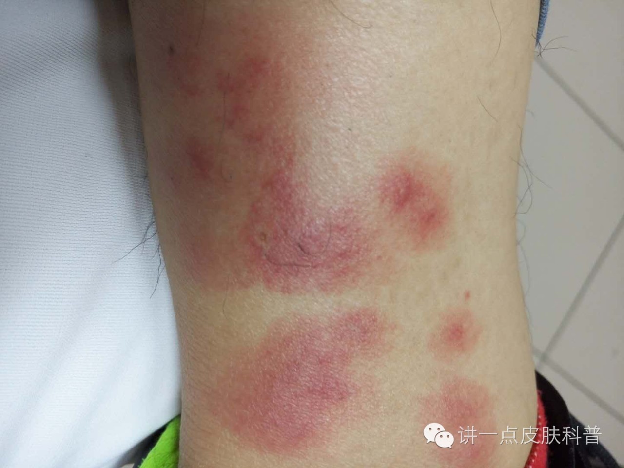 臭虫叮咬严重吗,被臭虫咬什么感觉