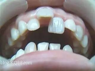 换牙注意事项以及禁忌,换牙期的十大禁忌