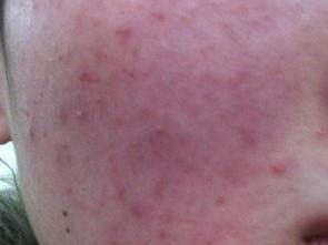 激素脸毛孔特别粗大怎么治疗,激素脸总是干燥起皮很痒怎么修复