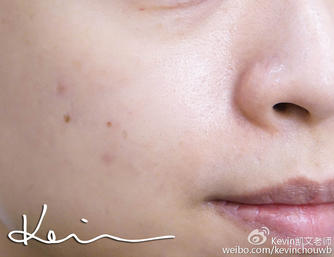 痘痘黑头粉刺用什么化妆品,痘痘粉刺黑头用什么化妆品