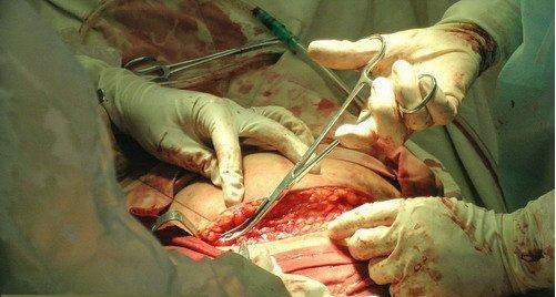 剖腹产必须知道的9个方面,剖腹产怎么才能轻松点