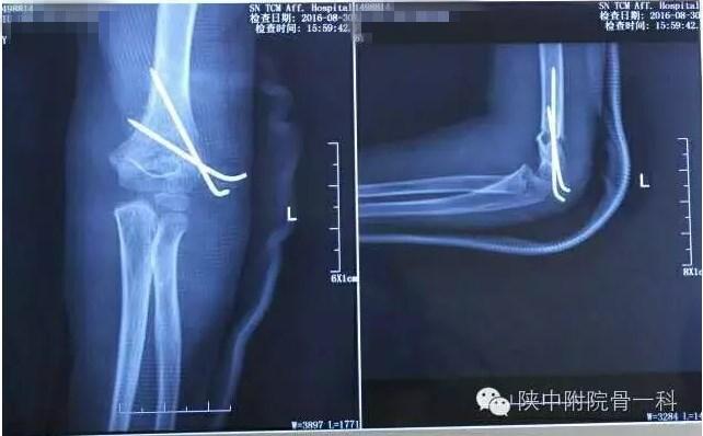 肱骨髁上骨折闭合复位手术记录,小儿肱骨髁上骨折手术恢复的概率