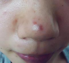 痘痘反反复复长的原因和应对方法,发际线两边痘痘反反复复一直冒痘