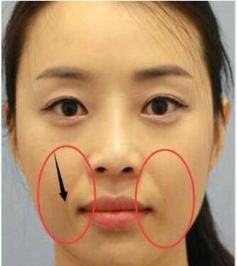 法令纹贴对去法令纹有效果吗,有了法令纹怎么办消除法令纹