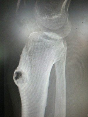 足球运动膝关节损伤康复,胫骨骨膜炎的治疗视频