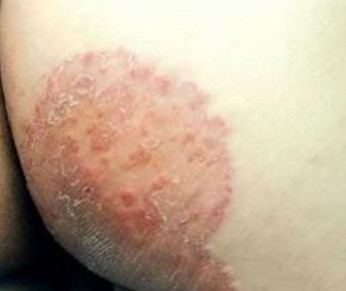 身上有股癣怎么治,身上有股癣怎么去除