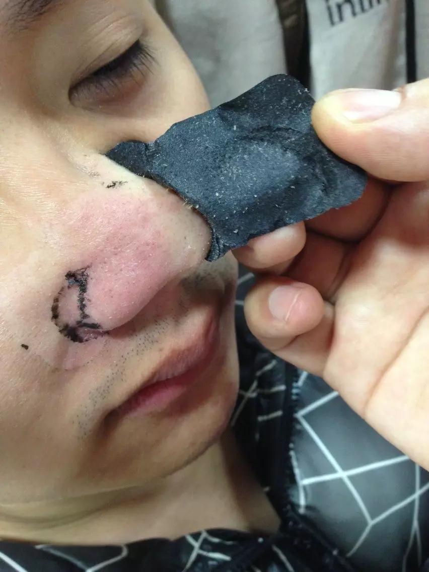 手把手教你有效去黑头的方法,手把手祛黑头