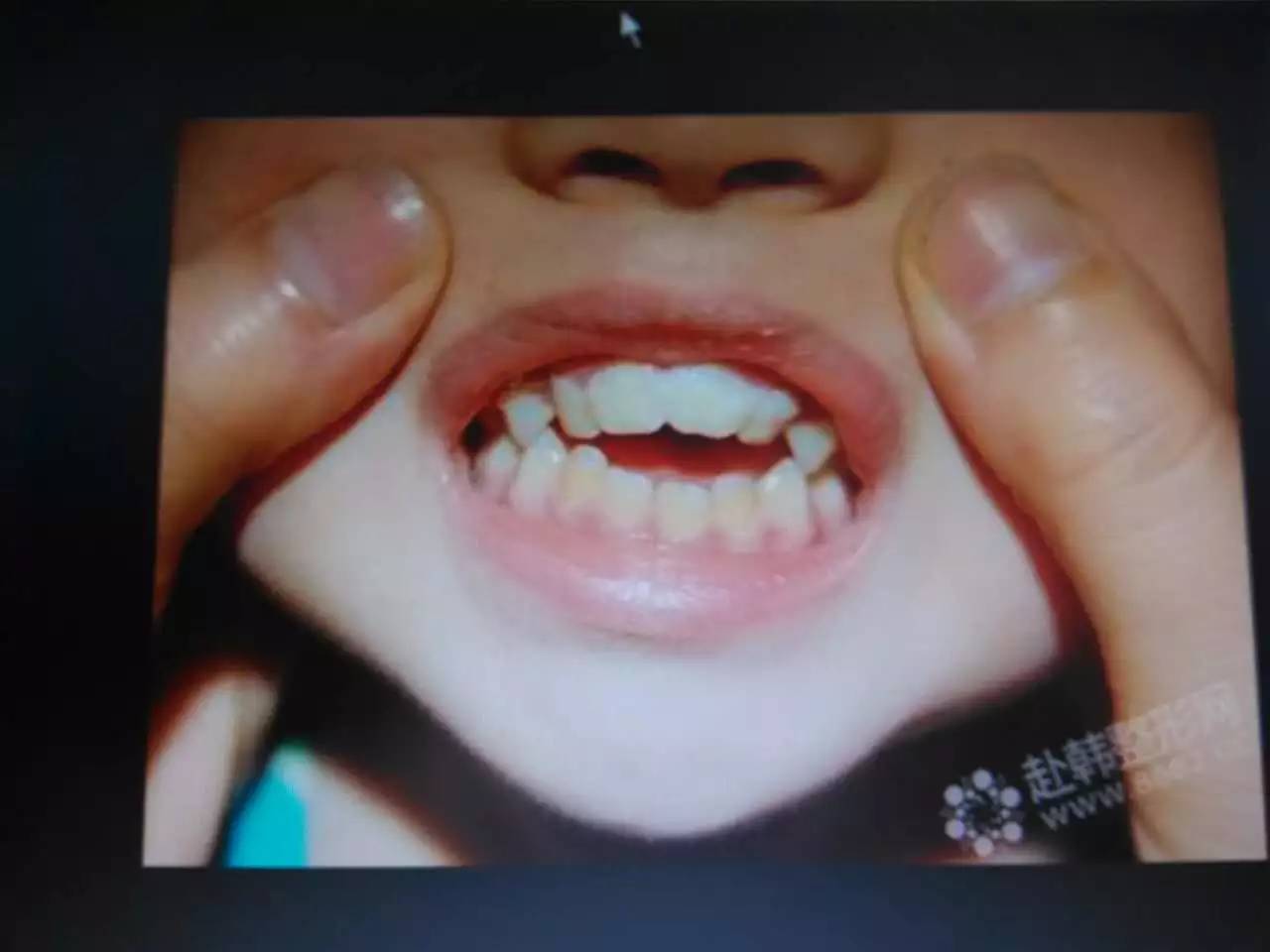 换牙注意事项以及禁忌,换牙期的十大禁忌